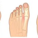 엄지발가락 관절 통증 원인 5가지 통풍만 의심하면 놓쳐요 이미지