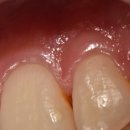 이사이치과의원 | 강동구 굽은다리역 이사이충치, 발견이 어려운 만큼 치료는 더 꼼꼼하게