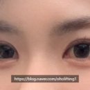 오호성형외과의원 네이버블로그