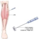 척수손상의 줄기세포 치료:임상에서 실험실로 본문설명 2 이미지