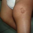 딤플 | 실리프팅 부작용 딤플 후기로 알 수 없는 이유