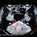 팔다리 수전증,보톡스 시술,자극 발생기 이미지