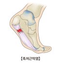 족저 근막염(Plantar Fasciitis ) 원인과 치료 이미지