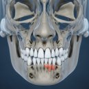 다모여 | 얼굴비대칭 교정기 비용 후기, 양악 싫은 사람 다 모여!