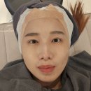 방배고운세상피부과의원 | 올리지오 후기 이수역 피부과 300샷 세로모공 잔주름 효과