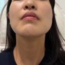 이웃한의원 | 창원 실리프팅 후기｜창원 한의원 실리프팅 내돈내산 코 실리프팅 받고 코끝 변화 대만족