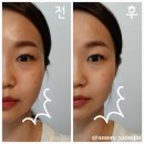 바바뷰티솔루션 | 팔자주름 모공 탄력 고민 10분 관리 프로 리프팅 앤 퍼밍 프로그램