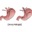 위,식도 역류성 질환 이미지