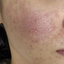 우린동물병원 | 여드름 패인흉터 복합치료 - 5회차 후기 (TCA, 쥬베룩볼륨, 서브시전, 어븀야그, 피코프락셀, 시크릿RF)