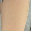 하나약국 | 하남 미사 피부 섬유종, 양성종양 제거 (실제 후기, 내돈내산)