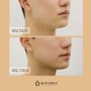 광주젠틀맥스? 더 매끈하게 받는 TIP [병원직접]