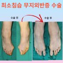 63세 여자환자 양측 무지외반증 수술 후기 (광주 선한병원)
