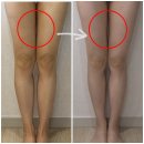 차뷰티 | 인천다이어트병원 허벅지 지방분해주사 2회차 후기 뷰티데이 태세리뷰