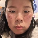 975 | 압구정 루나의원 루비레이저 975방 후기: 1일차