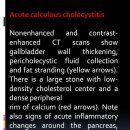 Acute calculous cholecystitis, CT 이미지