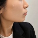 거상글로벌 | 청담피부과 원더트리플 청담실리프팅 후기 (40대 팔자주름 고민 해결)