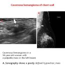 Cavernous hemangioma of chest wall 이미지