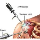 어깨회전근개파열로 인한 어깨 관절내시경 이미지
