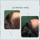 김천탈모커버 SMP 맞춤 시술, 김천의 디블랙아카데미 후기