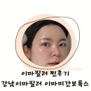 펜으로 그리는 세상 | 이마필러 잘하는곳 미간보톡스 이마필러 후기, 가격