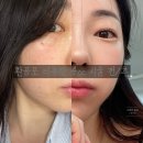 [강남] 신논현역 &#39;환공포리쥬란 4cc&#39; 건성피부 후기