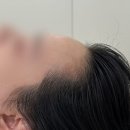 안양 범계 헤어라인 문신 | 자연스러운 M자 라인 교정 후기 | 모우 수수헤어라인