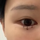 브리즈성형외과의원 | 성인안검내반 수술 후기, 보험청구 가능!