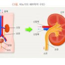 만성 급성 신우신염 원인 이미지