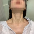 벨르 | 목주름필러 부작용 없는 가로 목주름관리법 벨르넥 후기♥