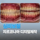신원비젼타워 | 전치부 심미보철, 지르코니아 디지털제작인데도 결과 차이가 나는 이유
