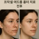 Dr. 클리닉 | 프락셀 여드름 흉터 치료 전후 효과 및 후기