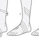 발목부상 을 치료 (추가 손상 을 방지하기 위해부상당한 발을 평가하고 부목) 이미지
