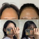 그녀의헤어라인의원 | 여성헤어라인 모발이식 비절개 후기(수술~14일차)모프로의원