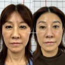 메리미에스테틱 | [공지] "[안산피부관리] 주름·탄력·미백 기미 관리 2회만에 이렇게 달라졌어요 | 메리미뷰티"