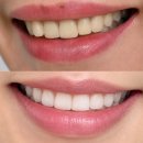 조아치과기공소 | 치아 무삭제 라미네이트 후기 치아미백, 교정, 배열 한번에 해결 완료 [내돈내산]