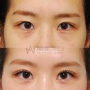 눈 수술 217. 매몰 쌍수 붓기 후기, 기간: 실밥제거-한달-6개월