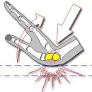 울산 손목 통증 주상골골절 / scaphoid fracture 이미지