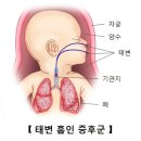 태변 흡인 증후군[Meconium aspiration syndrome]호흡기질환 이미지