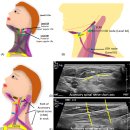 2. LEVEL II: UPPER JUGULAR NODES 이미지