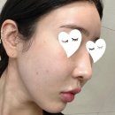 바른메디텍 | 차메디텍 리바이브PCL 모공스킨부스터 압구정역피부과 후기(효과,가격,통증)