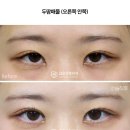디비성형외과의원 | 쌍꺼풀풀림 증상과 재수술 비용<디비성형외과 두땀매몰>