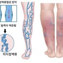현대병원 | 하지정맥류? 나도 몰랐는데, 내 다리 속에 있었대요! (아산현대병원 시술 후기)