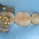 e사이언스치과의원 | 수원치과 어금니 골드인레이 속 크랙, 최소삭제 오버레이 크라운 치료 후기