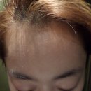 세가지소원의원 레이저토닝 후기 #3
