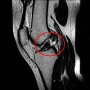 십자인대파열 증상과 mri 사진 이미지