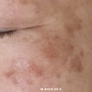 레이저 시술 후 붉은기 진정, 플라즈마 피부관리 후기울산 퀸뷰티샵 50대 여성 고객님 후기 ~