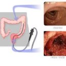 궤양성 대장염 혈변 원인 약 이미지