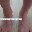 해맑은한의원 | 2025.07.19.토_해맑은 한의원 발목 삔 데 치료(전기치료, 에어마사지, 사혈, 침) | 평일 초진 11,900원...