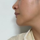 쿨뷰티클리닉 | 쿨소닉 가격 효과 등 피부 탄력과 라인 개선하고 온 강남 피부과 추천 후기