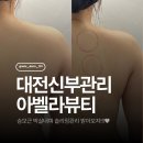 대전 승모근 관리 한방에 해결해준 아벨라뷰티 찐 후기